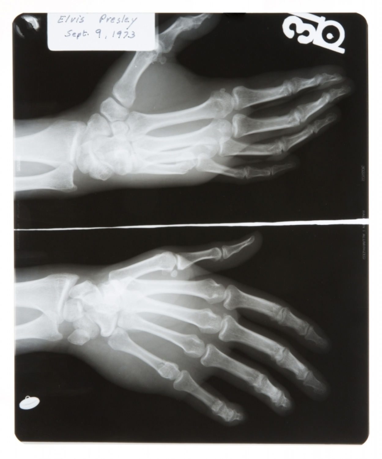 X Ray Hand1